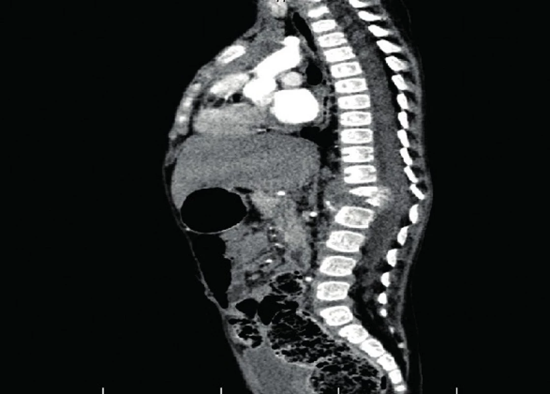 Spondylodiscitída Th12–L1 so zbortením tiel.
Fig. 4. Spondylodiscitis Th12–L1 with collapse of vertebras.