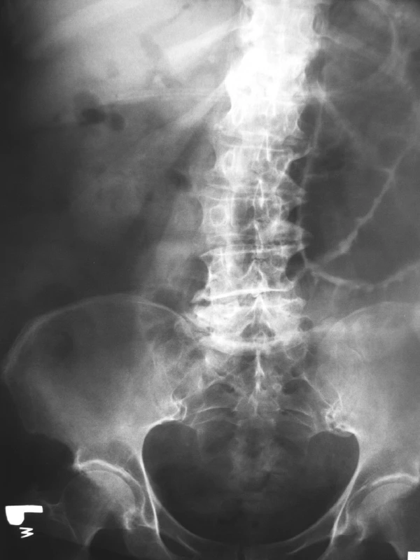 RTG abdomenu v stoji – aerobília (čierna šípka)
Pic. 3. X ray of abdomen in standing position – aerobilia (black arrow)