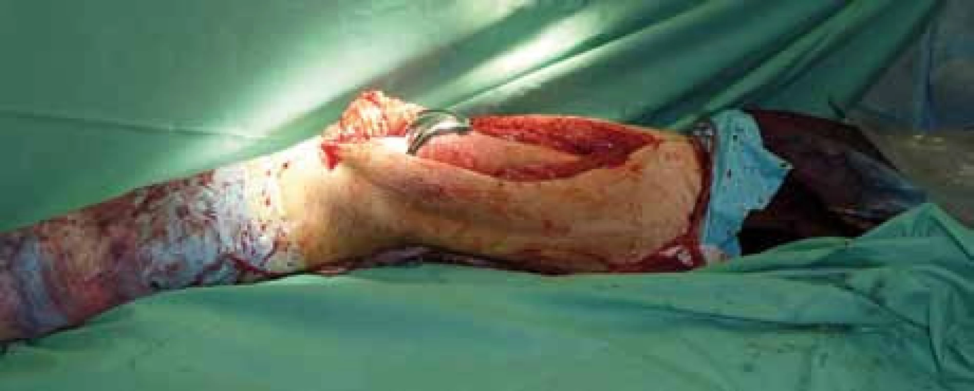 Peroperační foto – implantovaná kompozitní endoprotéza in situ.
