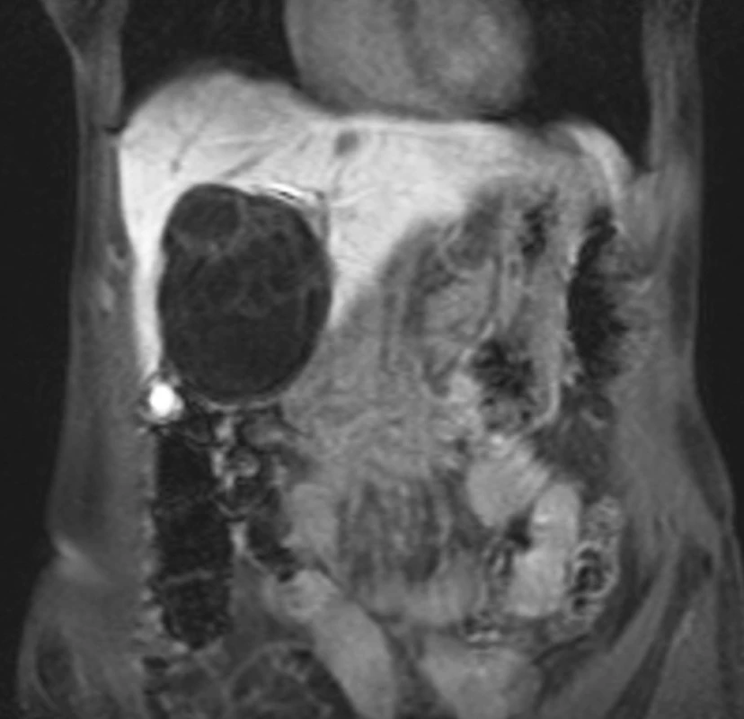 Biliární cystadenom jater s nepravidelnými okraji a septací
Fig . 6. Biliary cystadenoma of the liver with irregular margins, septated