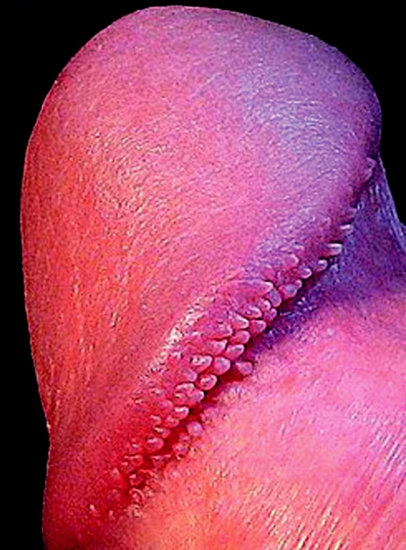 Papillae coronae glandis.
