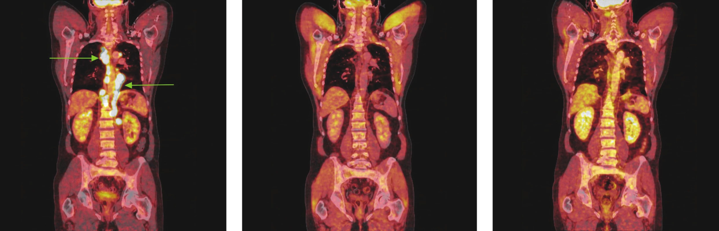 Série PET/CT snímků u téhož nemocného s difuzním B-velkobuněčným lymfomem před léčbou, po 2 cyklech léčby a po ukončení léčby. První snímek ukazuje mnohočetná ložiska hypermetabolismu glukózy ve zvětšených lymfatických uzlinách zvětšených lymfatických uzlinách ve všech oddílech mediastina a kolem bříšní aorty. Po 2 cyklech léčby došlo ke zmenšení všech lymfatických uzlin, žádná nevykazuje hypermetabolismus glukózy a po skončení léčby je patrná normalizace velikosti lymfatických uzlin, všechny bez hypermetabolismu glukózy.