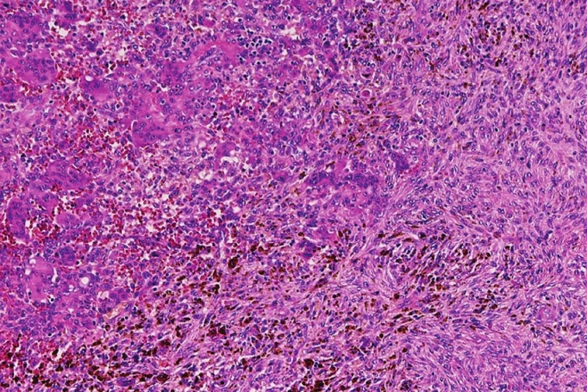 Hnědý nádor při heperparatyreóze je neodlišitelný od pravého obrovskobuněčného nádoru. HE, x100.