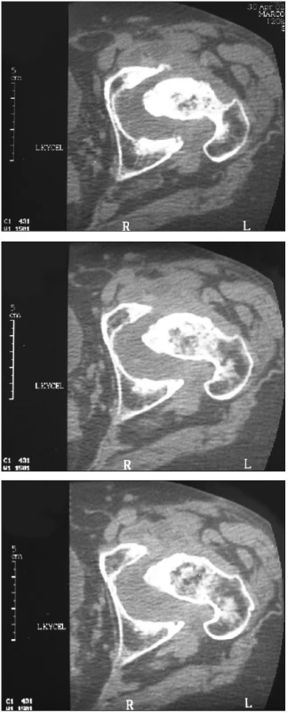 a-c. CT obraz destrukce hlavice femoru l.sin. při v.s. prorůstajícím tumor