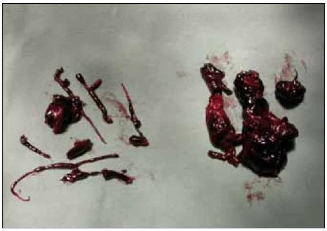 Vpravo – emboly vybavené přímo z kmene plicnice a jejích větví, vlevo – emboly vyplavené při retrográdní perfuzi od téhož pacienta.