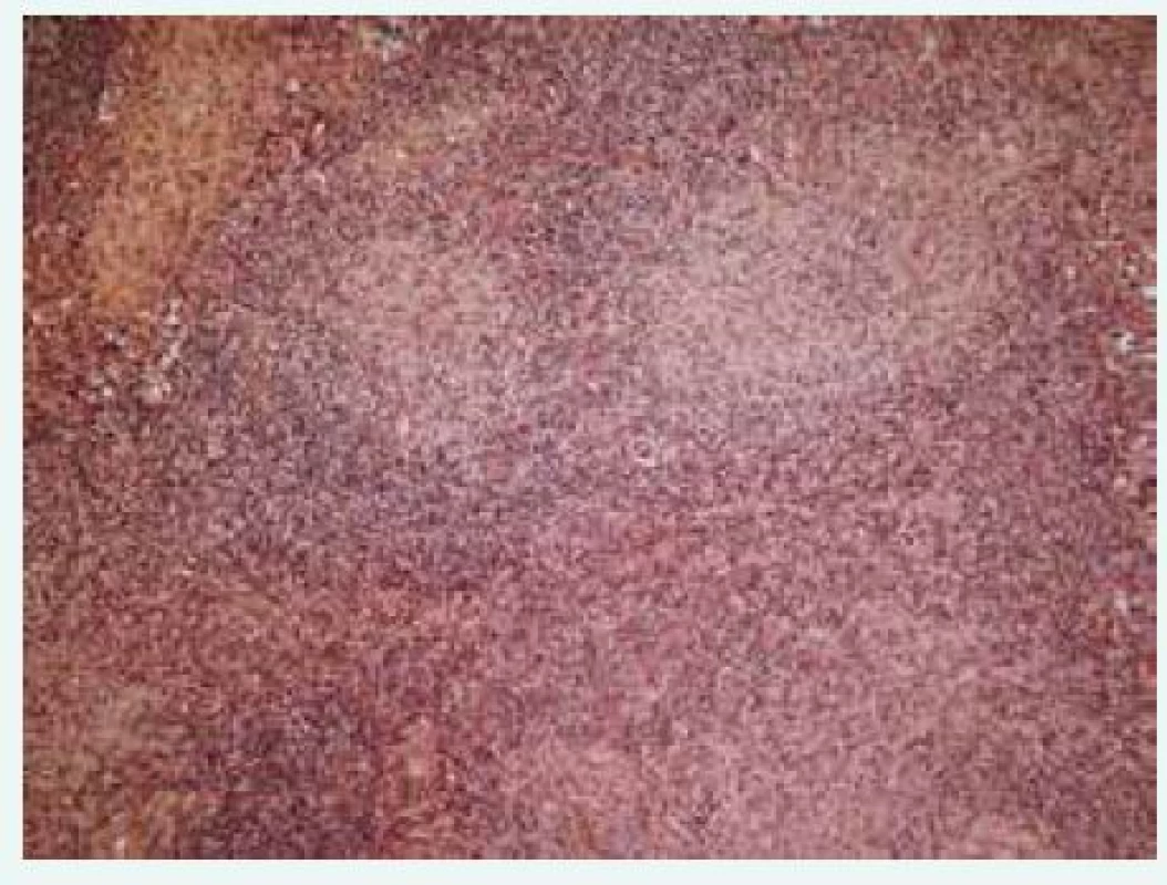 Histologický průkaz granulomů u pacienta s CVID. Granulomy při CVID se podobají granulomům u sarkoidózy. Jsou menší, bez nekróz, na rozdíl od sarkoidózy jsou však hůře ohraničené. Morfologie granulomů při CVID je ovšem variabilní a závisí na případném přidruženém infekčním onemocnění. V literatuře jsou v souvislosti s CVID popisovány také granulomy s kaseózními nekrózami (Histopatologický obrázek poskytl MUDr. Mojmír Moulis)