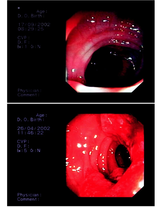 A) Normální obraz tlustého střeva při koloskopii
B) Zhoubný nádor střeva částečně obturující lumen – možná příčina sekundární zácpy
