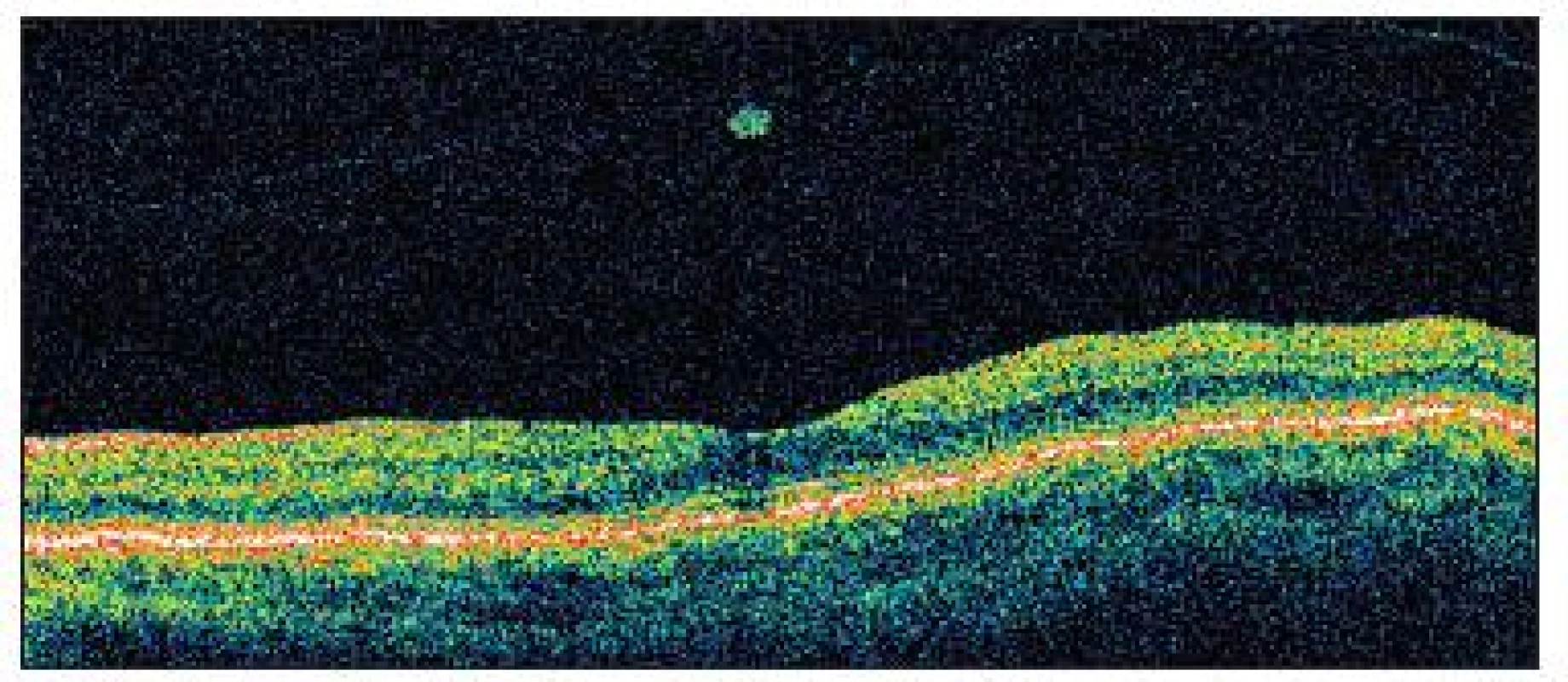 OCT u pacientky č. 2 po 14 mesiacoch od prvého vyšetrenia znázorňuje správnu architektúru fovey a abláciu zadného sklovca s hyperreflektívnym tkanivom, zrejme zvyšok po vitreomakulárnej adhézii snáď aj s ostrovčekom neurosenzorickej sietnice