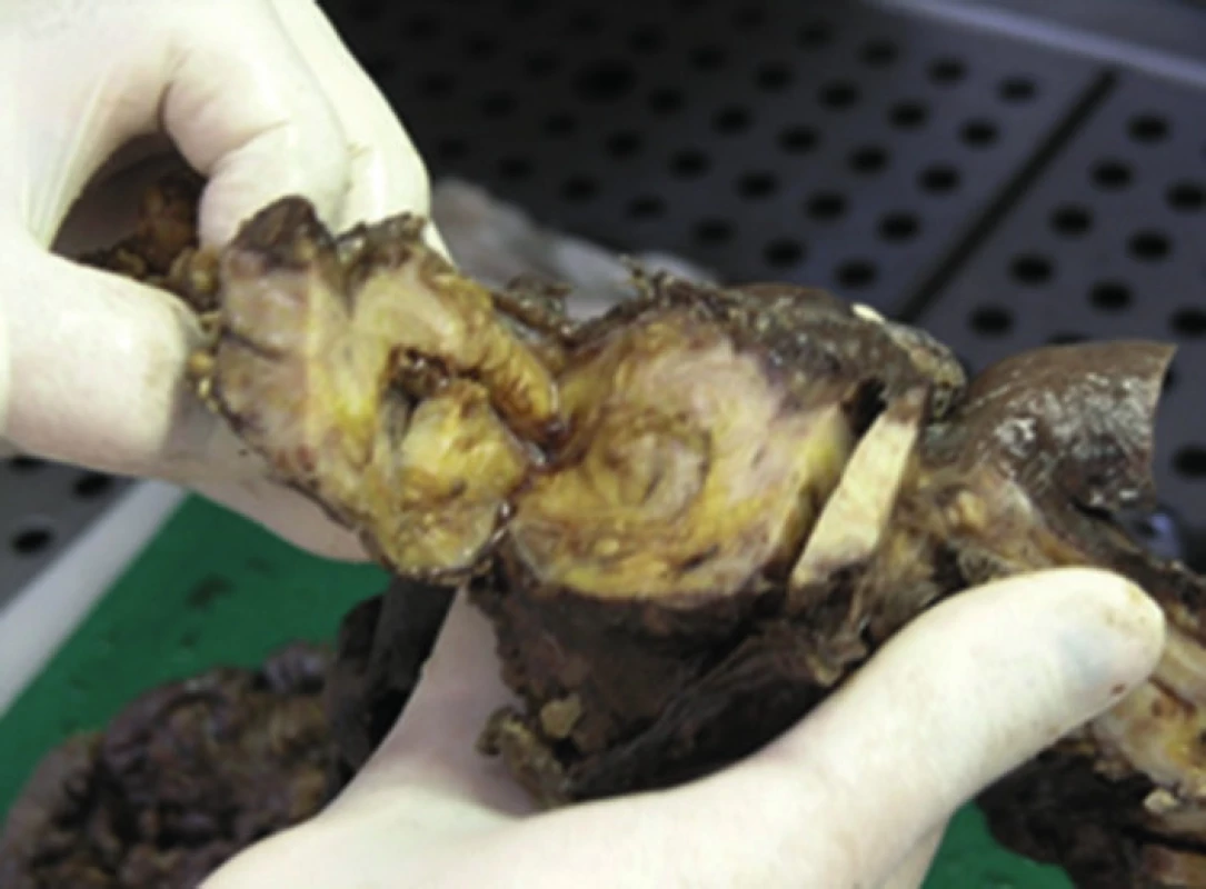 Makroskopické pitevné nálezy poukazujú na rozsah a hrúbku osifikácie zostávajúcej časti čreva
Fig. 7: Macroscopic autopsy findings indicate the extent and thickness of ossification of the residual part of the intestine