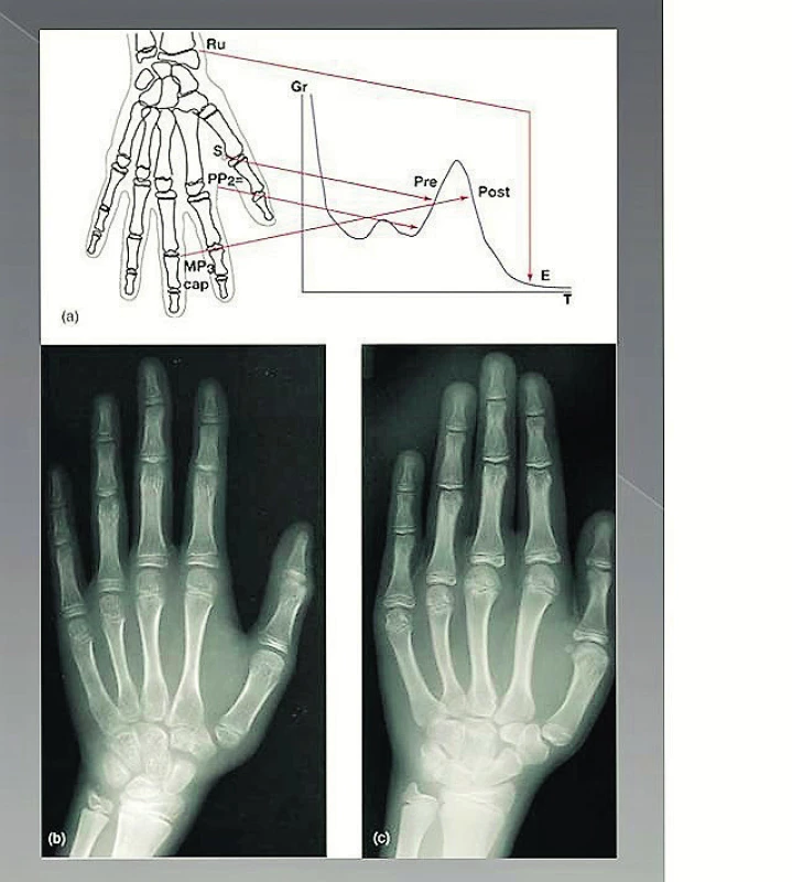 RTG snímky zápěstí, ruky: na RTG posuzujeme distální epifýzu radia a ulny, třetí a pátý metakarp, proximální, střední a distální falangy prvního, třetího a pátého prstu a sedm karpálních kostí. Na obrázku je graf schematicky znázorňující růst (Gr) v čase (T)
(a) Rentgenový snímek zápěstí – ruky se využívá k sestrojení růstové křivky. Sezamová kůstka (S) palce začíná obvykle kalcifikovat v průběhu akcelerační fáze pubertálního růstového spurtu (PRE). Protože růst bude ještě výrazně pokračovat, není tato doba vhodná pro zavedení implantátu. Uzavírání středních falangů prostředníčku ruky (MP3cap) obvykle nastává po maximálním růstovém spurtu a indikuje zpomalení pubertálního růstového spurtu (postpubertální POST). Tento jev koreluje u dívek se začátkem menstruace a u chlapců se změnou hlasu. Od doby, kdy pubertální růst je z většiny ukončen, je možné začít uvažovat o zavedení implantátu. (Op Heij, G. D., Opdebeeck, H., Van Steenberghe, D., Quirynen, M.: Age as compromising factor for implant insertion. Periodontol. 2000, 2003 , roč. 33, č. 1, s. 172–184)
(b) Rentgenový snímek zápěstí dítěte. PP2 = vývoj kosti je v počátečním stadiu růstu
(c) Rentgenový snímek zápěstí dítěte. Mpcap = indikuje, že maximální rychlost růstu je ukončena, ale skletální růst ještě není ukončen a erupce zubů je tak možná