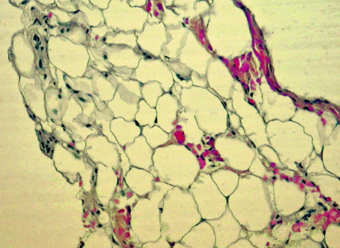 Průkaz amyloidu v tukové tkáni (barvení Saturnovou červení, objektiv 10krát)