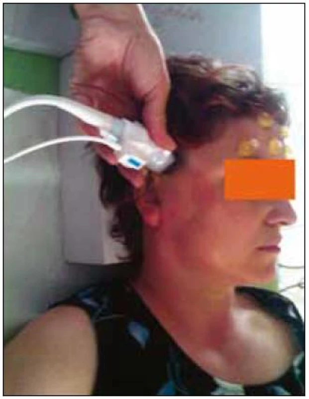 Transkraniální duplexní sonografické vyšetření s využitím fixace hlavy z důvodu udržení stabilní pozice hlavy.