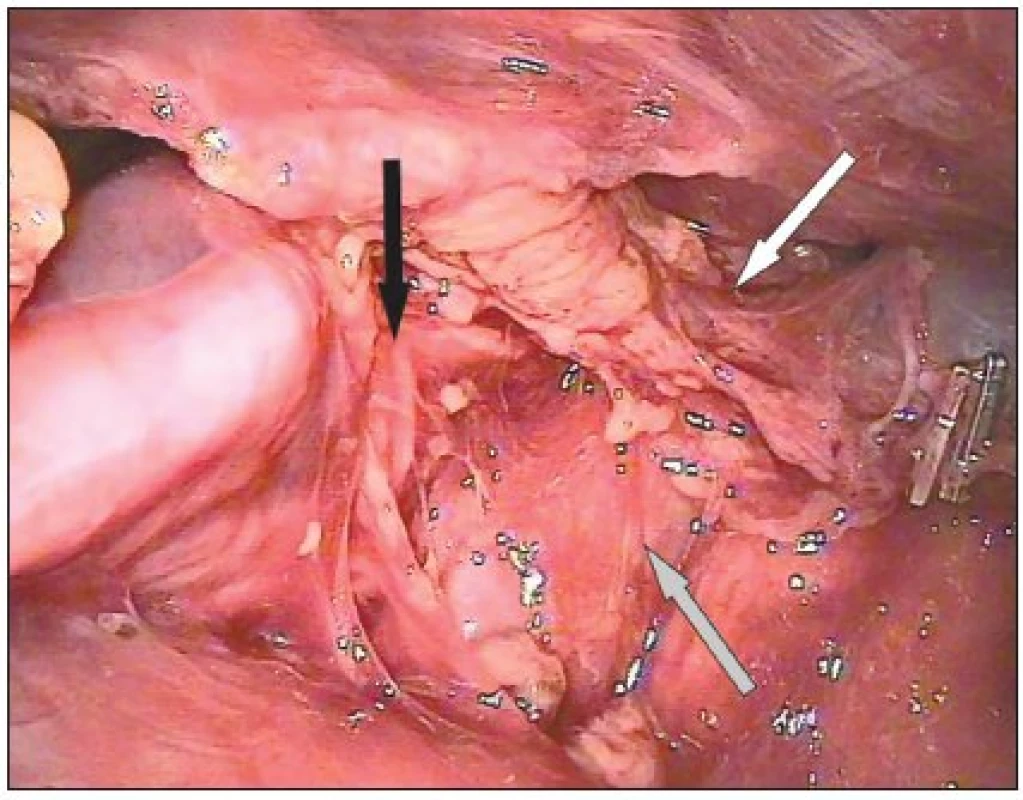Pohled zleva na mediastinum. Vústění pravostranné v. thoracica interna (bílá šipka), horní dutá žíla (šedá šipka) a pravostranný frenický nerv (černá šipka) 
Fig. 5. Left lateral view to the mediastinum. Confluens of the right internal thoracic vein (white arrow), superior vena cava (grey arrow), and the right phrenic nerve (black arrow)