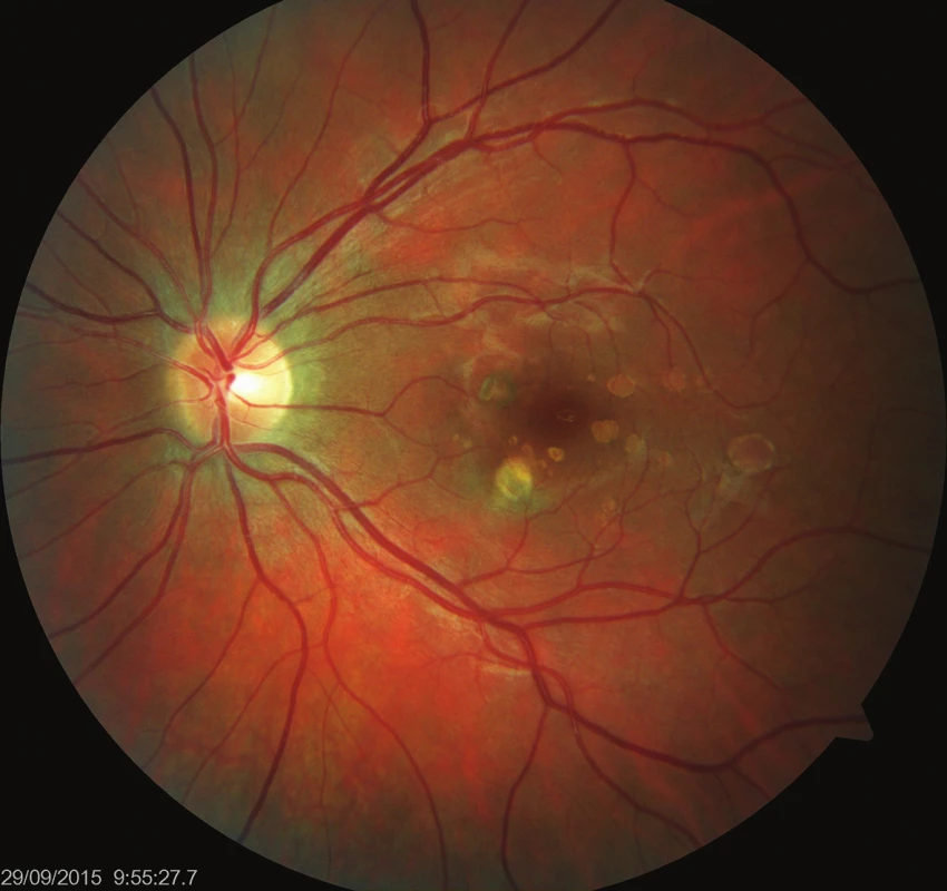 Levé oko. Původní aktivní ložisko na sítnici se postupně ohraničuje a částečně pigmentuje