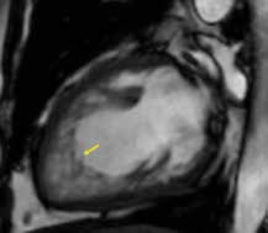 Hypertrabekulizace s hlubokými intertrabekulárními recesy (žlutá šipka) v oblasti hrotu levé komory  u nemocného s nonkompaktní kardiomyopatií;