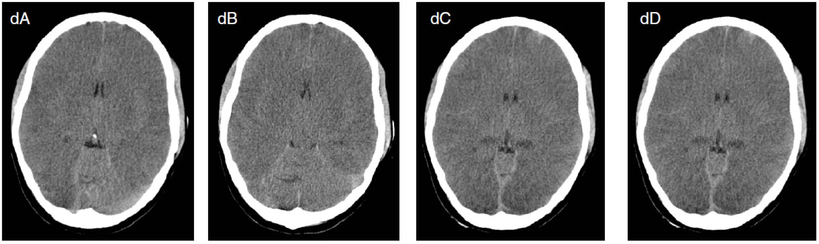 Osmnáctiletá pacientka byla přijata po KPCR po otravě oxidem uhelnatým a topení ve vaně. Od přijetí v těžkém kómatu. Na EEG jsou přítomny suspektní, lokalizačně měnlivé iktální vzorce (šipky na obrázcích a, b), které vymizí po aplikaci DZP (c). Na CT mozku je přítomen těžký otok mozku (d). Pacientka umírá za měsíc za příznaků multiorgánového selhání.