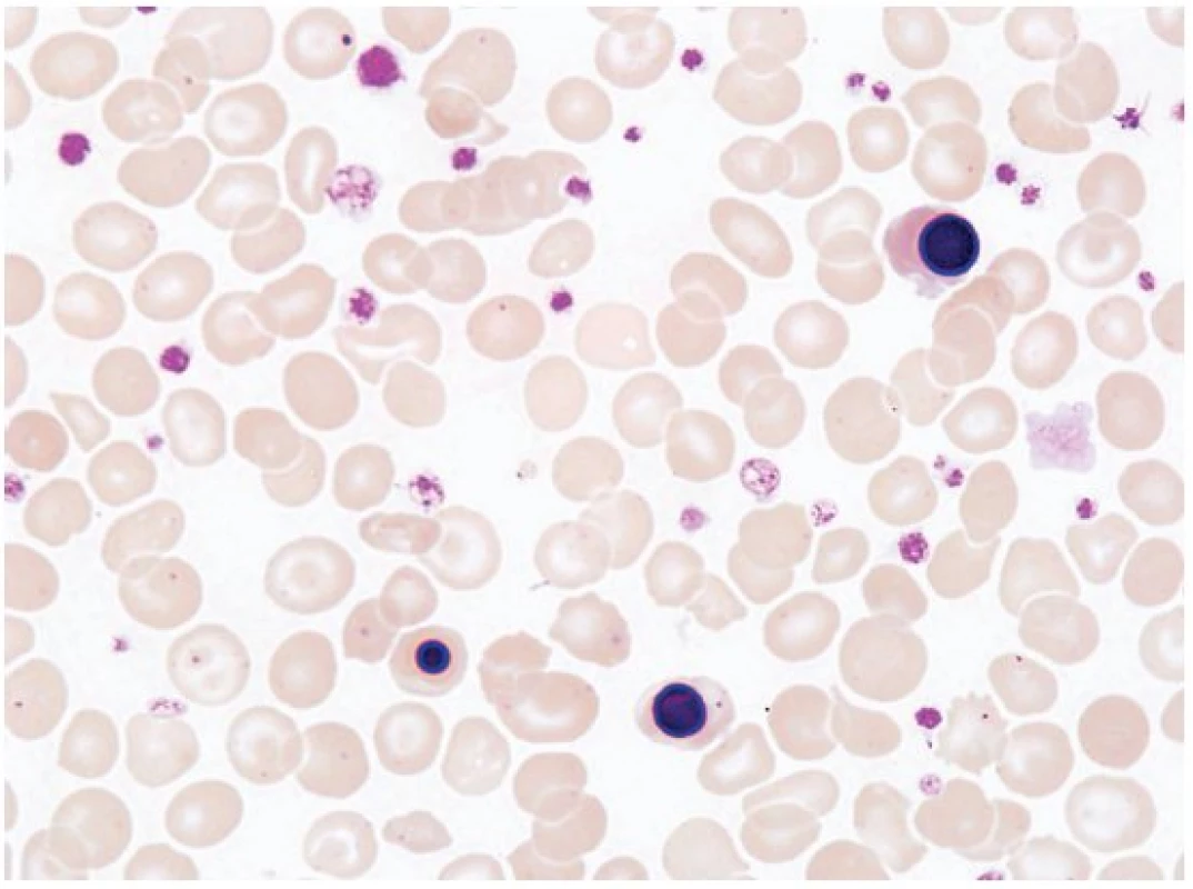 Nátěr periferní krve. Nález přítomnosti normoblastů v periferní krvi může upozornit na možnost primární myelofibrózy či postižení kostní dřeně nádorovým onemocněním.