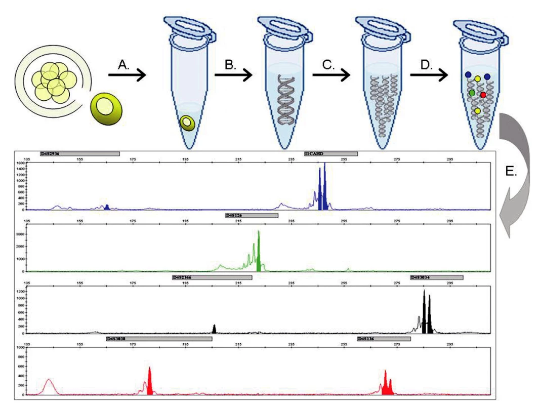 Metodický postup molekulárně genetické PGH:
(A) Biopsií je z embrya 72 hodin po fertilizaci odebrána buňka a přenesena do lyzačního roztoku. (B) Genom jediné buňky je uvolněn z jádra a (C) mnohonásobně namnožen v procesu celogenomové amplifikace. (D) Produkty celogenomové amplifikace jsou následně podrobeny multiplexní fluorescenční PCR reakci, kde se specificky amplifikují sekvence markerů ve vazbě k vyšetřovanému genu. (E) Fragmentační analýzou pomocí kapilární elektroforézy je určen genotyp vyšetřovaného embrya.