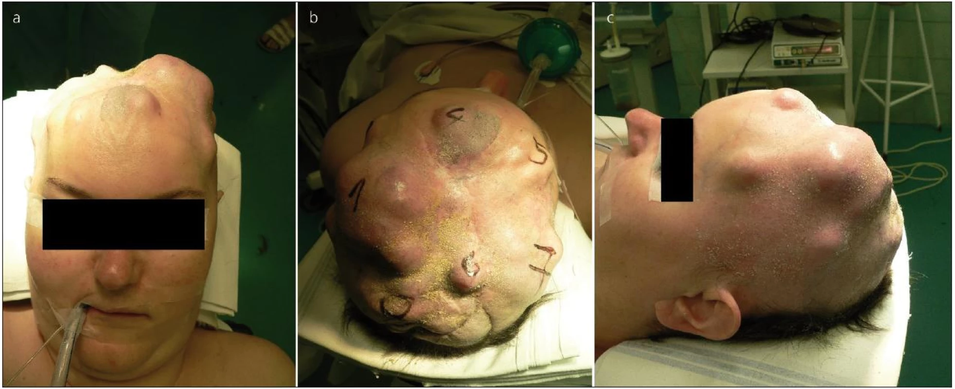 Pacientka před jednou z exstirpací v podkoží recidivujícího meningeomu.