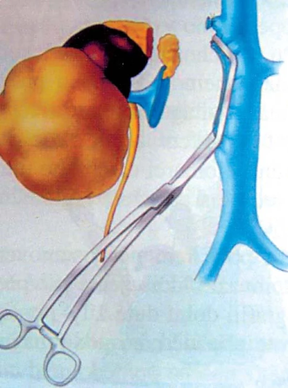 Tumor pravé ledviny s trombem hladiny I–II (resekce DDŽ) [24].