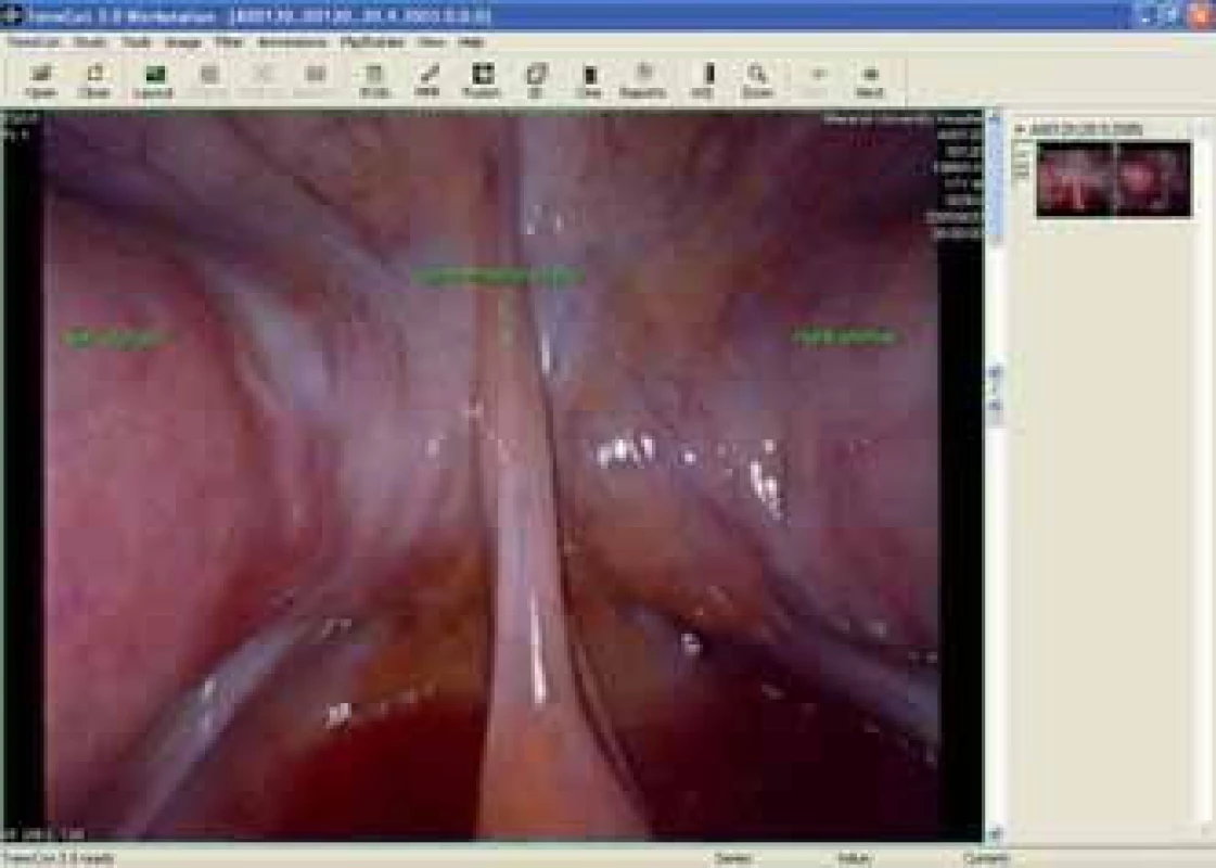 Snímek z laparoskopie - uterus duplex.