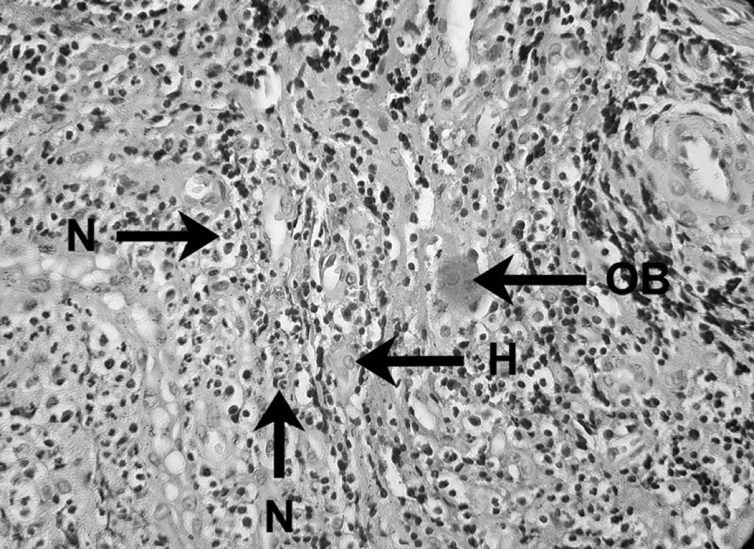 Zápalový bunkový infiltrát prítomný v periapikálnom granulóme
V histopatologickom obraze lézie možno vidieť neutrofily (N), histiocyt (H) a obrovskú bunku (OB) – autor Ján Kováč. 
Fig. 3. Inflammatory cell infiltrate in periapical granuloma 
Histopathological image of the lesion shows neutrophils (N), a histiocyte (H), and a giant cell (OB) – Author Ján Kováč.