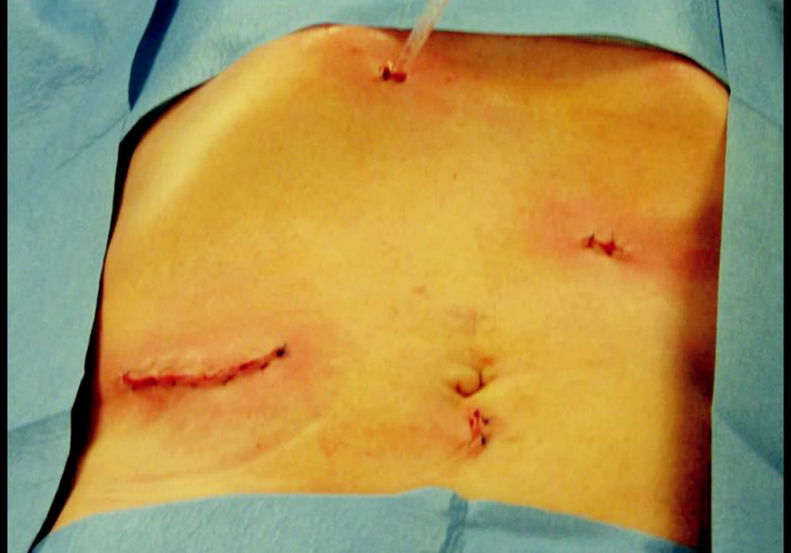 Kosmetický výsledek na konci operace
Fig. 4. Cosmetic outcomes at the end of the procedure