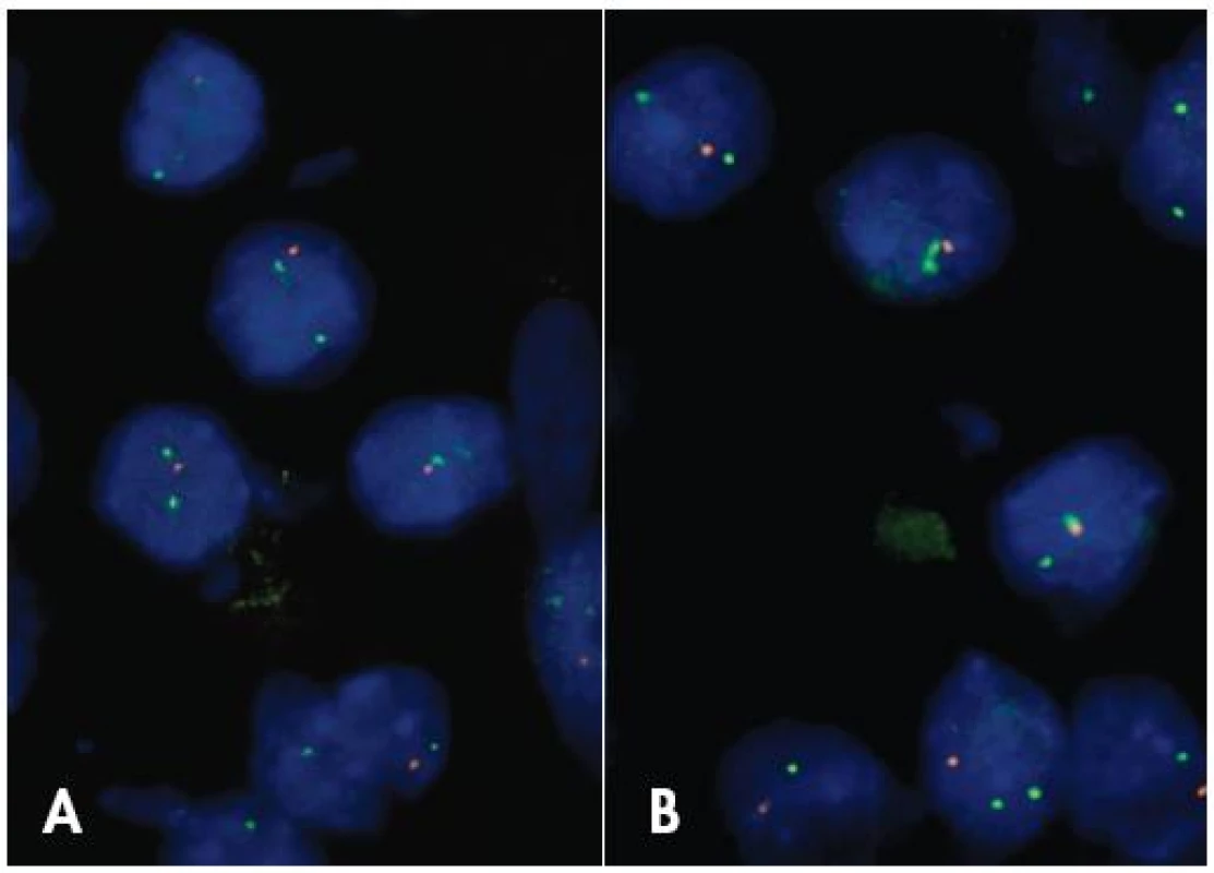 FISH anaýza delécie 1p (A) a 19q (B) v oligodendroglióme. V nádorových bunkách je jeden oranžový signál (strata 1p36 resp. 19q13) a dva zelené kontrolné signály, zväčšenie 1000 x.