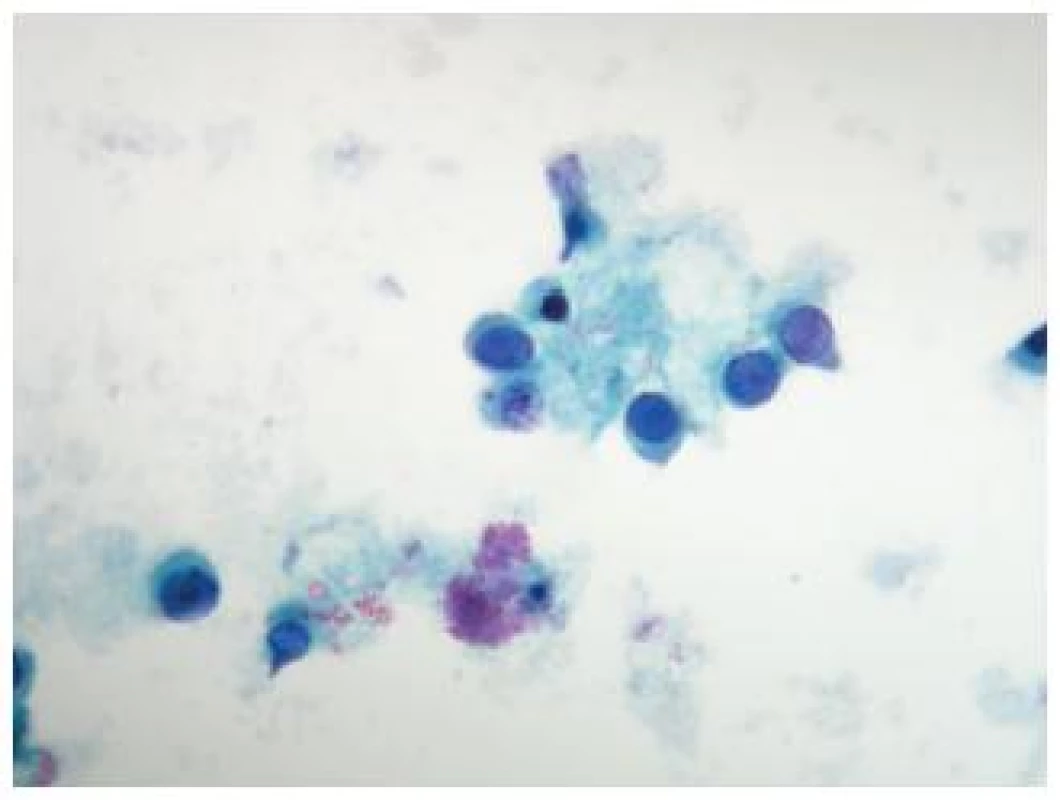 Bunka spĺňajúca morfologické kritéria pre „Decoy cell“ v moči pacienta s transplantovanou obličkou s imunohistochemicky potvrdenou infekciou vírusom polyoma BK. (Cytospinový preparát, farbenie PAP, zväčšenie 400x.)