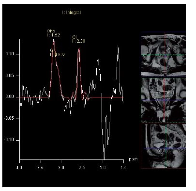 MR spektroskopie – elevace hladiny cholinu a pokles citrátu v levém laloku prostaty
Fig. 2. MRI spectroscopy – elevation of choline level with a decrease in citrate level is the spectral signature of prostate cancer in the left lobe