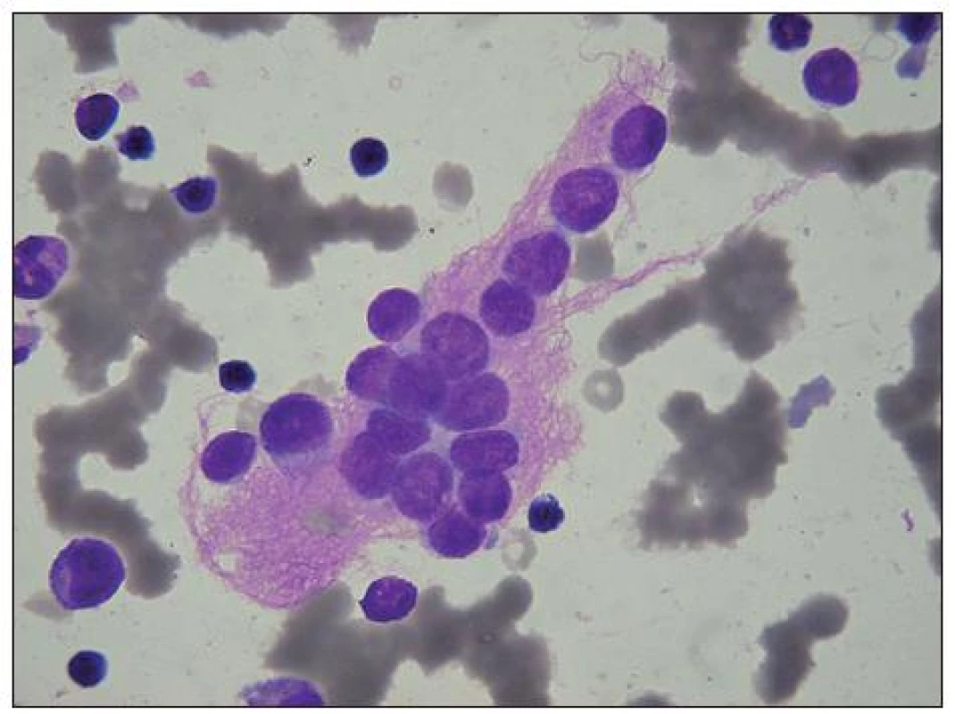 Neuroblastom: velký svazek růžovofialových neurofibril, obklopujících metastázu neuroblastomových buněk
v KD. U některých není patrná cytoplazma. V okolí několik malých lymfocytů, u levého okraje myelocyt, nad ním metamyelocyt (na obrázku četné erytrocyty v rouleaux).