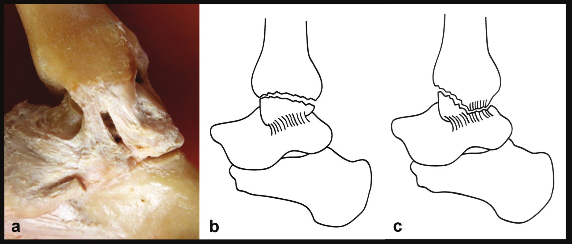 Rozdíl mezi zlomeninou vnitřního kotníku a kombinovaným osteo-ligamentózním poraněním
a – anatomie mediálních struktur, jsou patrné obě části deltového vazu, b – zlomenina vnitřního kotníku, deltový vaz je intaktní, c – kombinované osteo-ligamentózní poranění, je odlomen přední kolikulus a přetržena tibio-talární část deltového vazu. Na volně adaptovaných Tornettových schématech [15] se pro zjednodušení upíná deltový vaz pouze na talus, což neodpovídá realitě.
