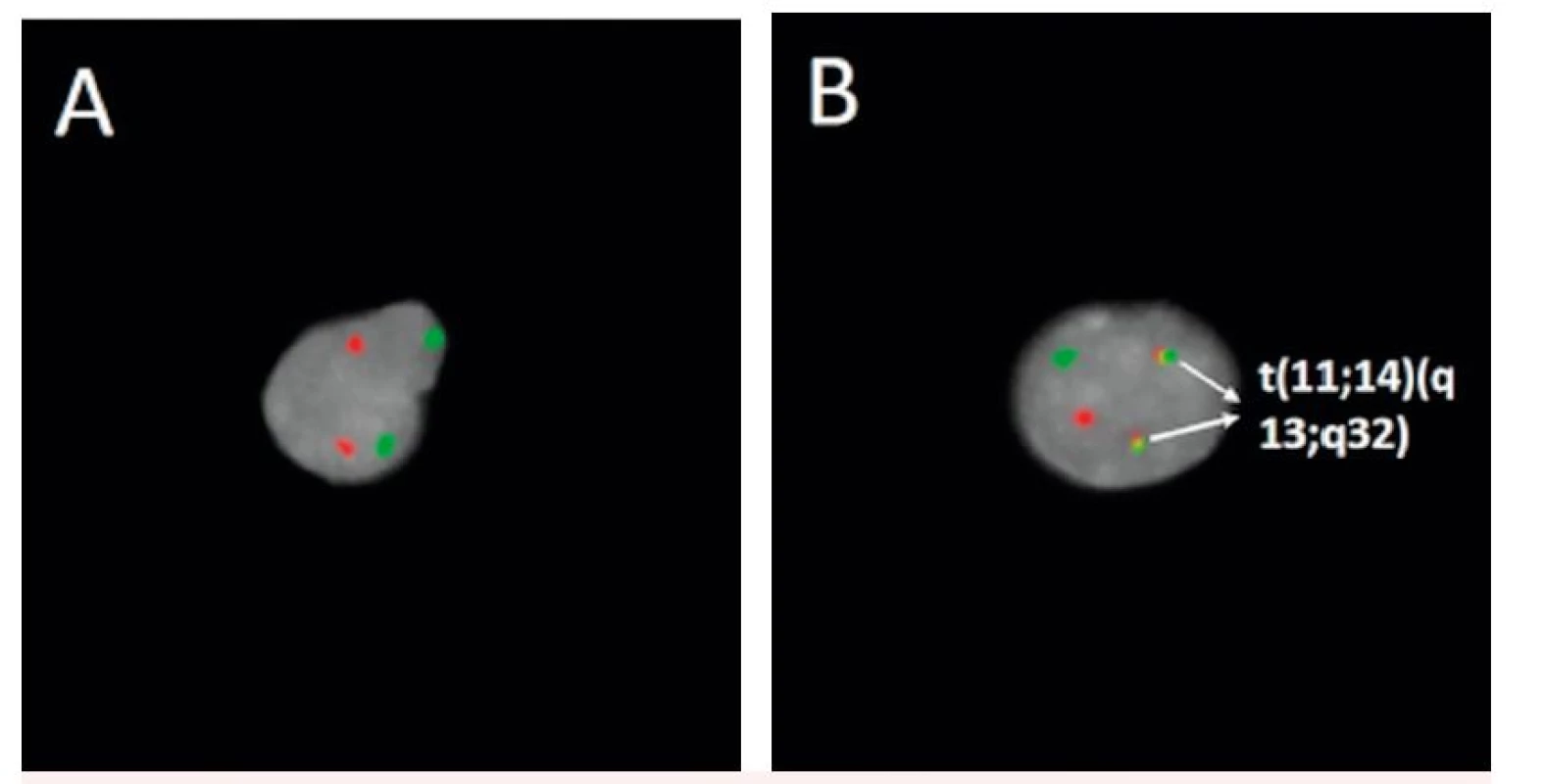 Detekce t(11;14)(q13;q32) fluorescenčně značenou genovou sondou 
A – negativní nález, B – pozitivní nález (označeny šipkami)