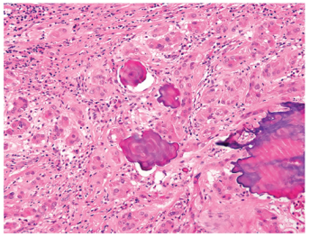Velkobuněčný kalcifikující nádor ze Sertoliho buněk s nápadnými ložisky koncentrické a lamelární kalcifikace. Barveno hematoxylinem eozinem (zvětšení 200x).