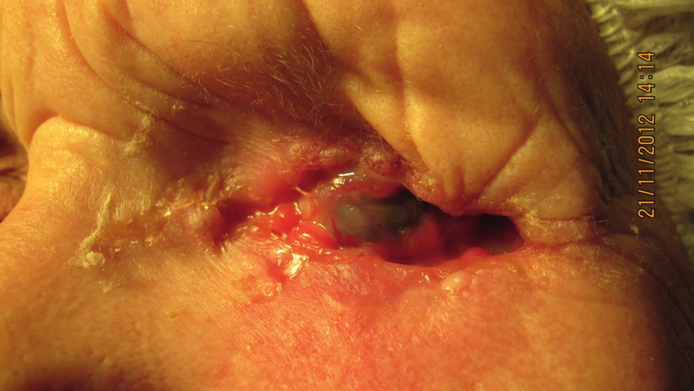 Pacientka, nar. 1941, klinický obraz infiltrujúceho bazocelulárneho karcinómu do očnice pri prijatí na hospitalizáciu a indikácii exenterácie očnice (11/2012)