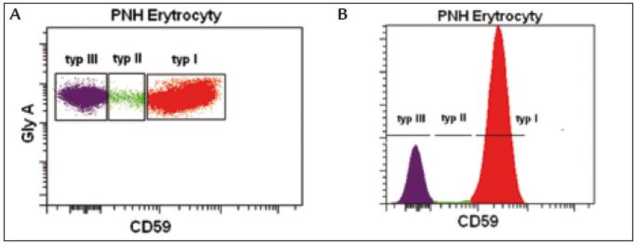 PNH erytrocyty s kompletním deficitem GPI kotveného proteinu CD59 (typ III), PNH erytrocyty s částečným deficitem (typ II) a normální erytrocyty (typ I).