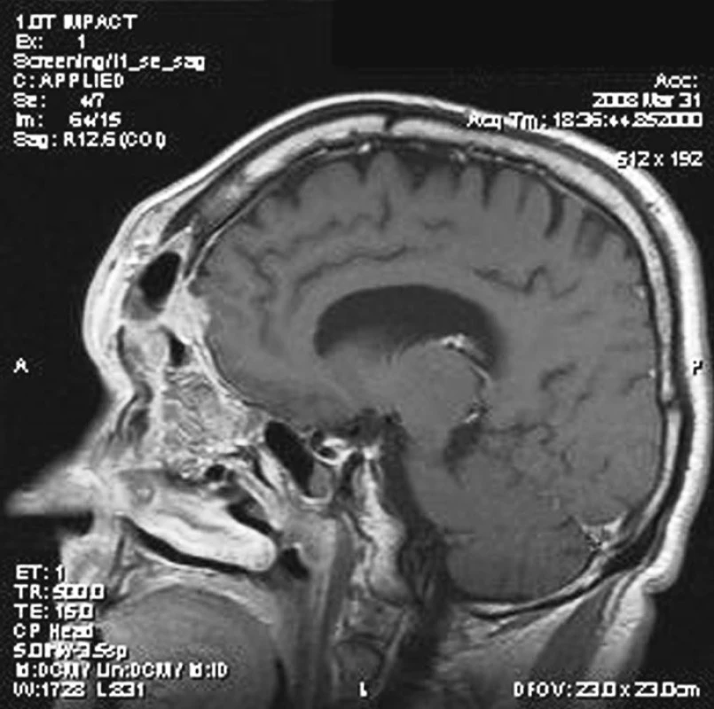 Pooperační změny v čelní dutině s reziduem nádoru, který infiltruje tvrdou mozkovou plenu (MR vyšetření v sagitální projekci v T1 váženém zobrazení po podání kontrastní látky).