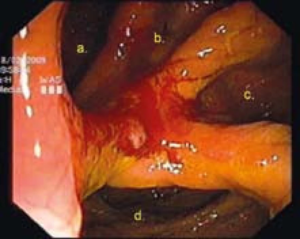 Kolonoskopia: gastrokolická fistula v oblasti zadnej gastroenteroanastomózy sec. Hacker: a = žalúdok, b + c = jejunálne kľučky Braunovej anastomózy, d = colon transversum.
Fig. 3. Colonoscopy: gastrocolic fistula in vicinity of the gastroenteroanastomosis sec. Hacker: a = stomach, b + c = jejunal loops of Braun’s anastomosis, d = transverse colon.
