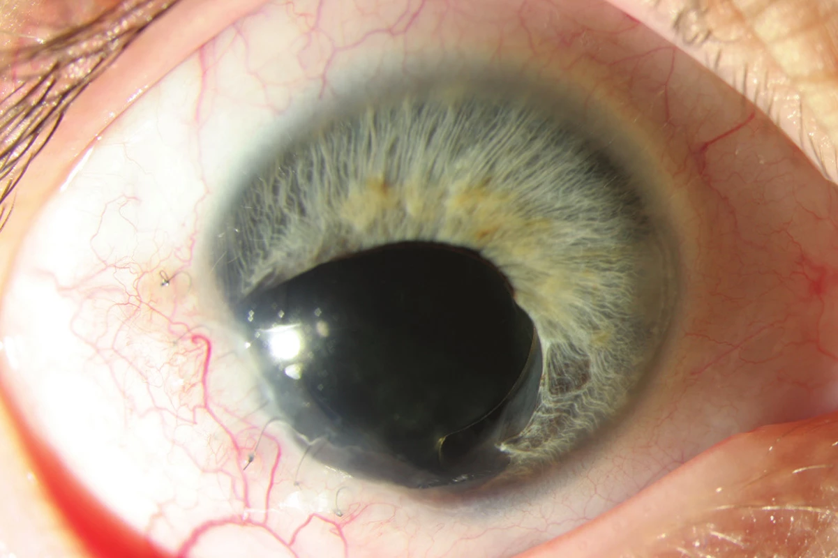 Pravé oko po excizi melanomu duhovky a výměně čočky