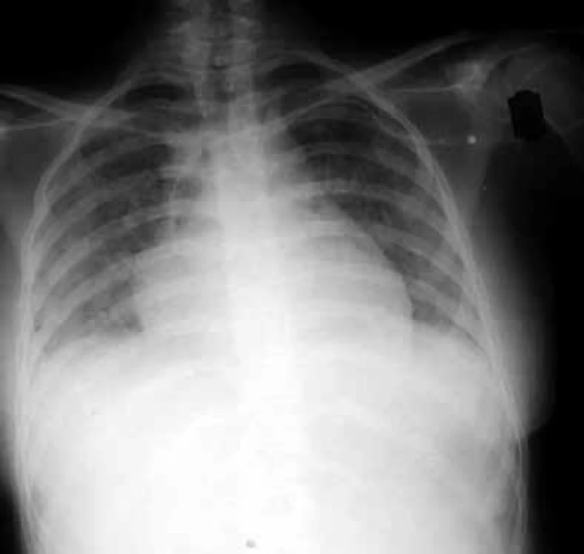 Zadopřední skiagram hrudníku nemocného s cytomegalovirovou pneumonií