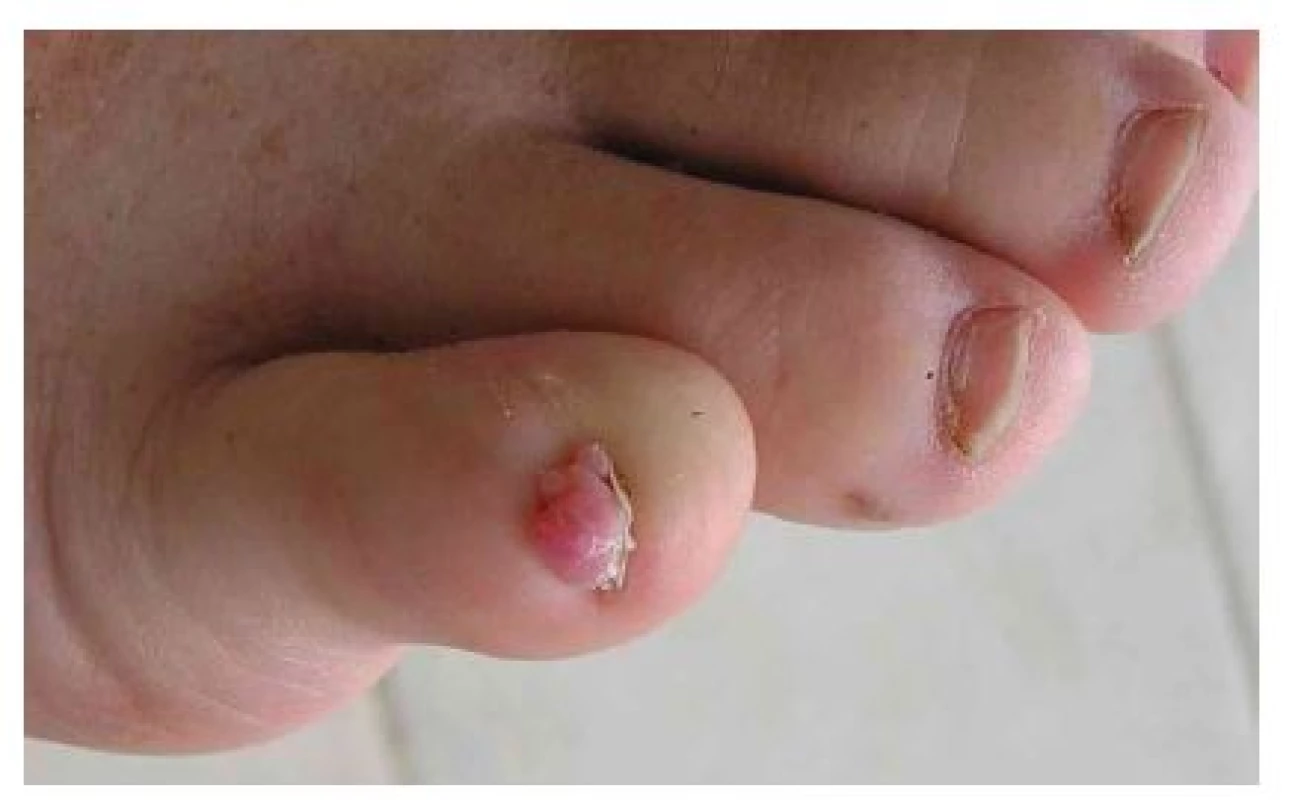 Unguální fibrom na malíku pravé nohy dospělé ženy s tuberózní sklerózou