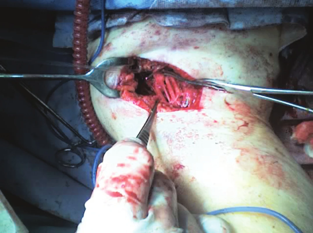 Uvnitř brachiálního plexu patrna zúžená poškozená axilární tepna
Fig. 3. The injured, narrowed axillary artery is detectable within the brachial plexus structures