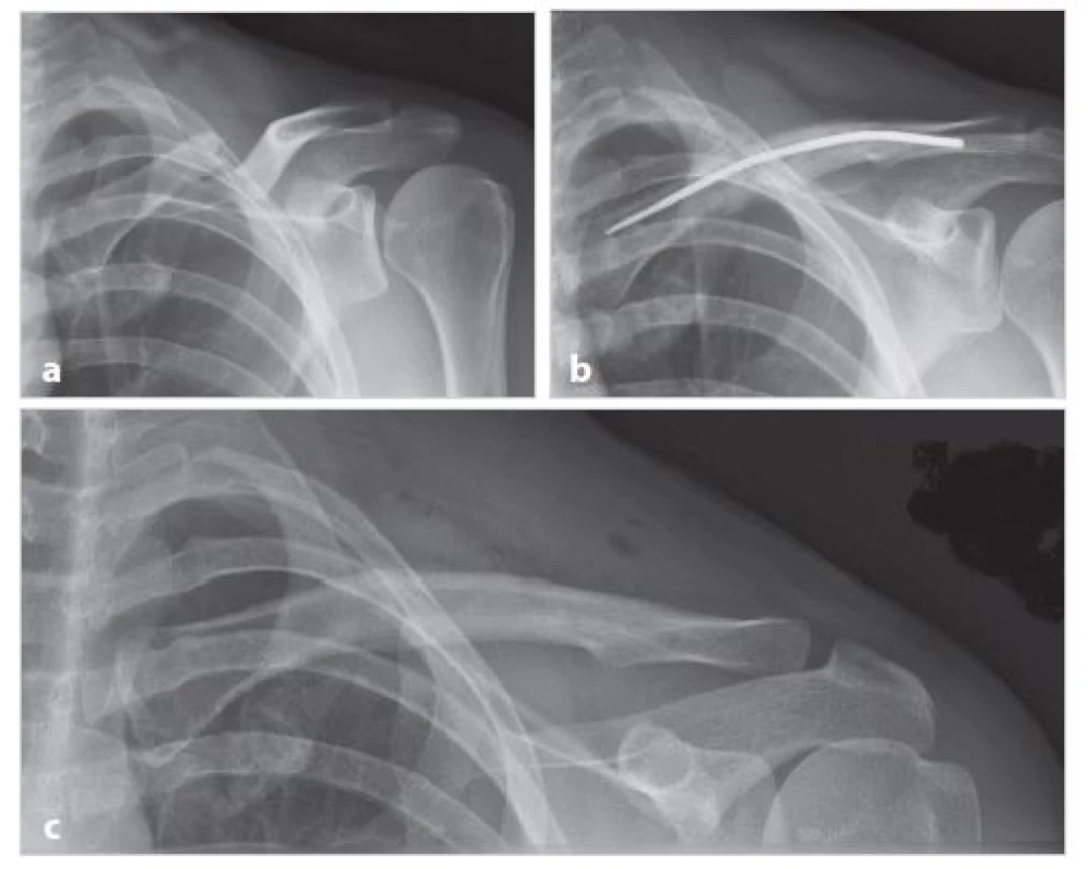 Dobré hojení při stabilizaci zlomeniny anulovaným implantátem (muž P. H., 29 let)
a) úrazové snímky dvoufragmentové zlomeniny klíční kosti; b) tři měsíce po operaci s nálezem angulovaného implantátu; c) stav po zhojení zlomeniny a extrakci osteosyntetického materiálu v 8 měsících od úrazu
Fig. 4: Good fracture healing by stabilization with bending of implant (male P.H., 29 years)
a) X-ray of a two-fragment fracture taken after the injury; b) three months after the surgery showing bent implant; c) the condition after healing of the fracture and extraction of the osteosynthetic material at eight months from the accident
