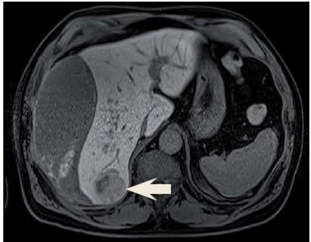 Ložisko VII. segmentu pravého jaterního laloku, pravděpodobný adenom.
Fig. 3. Focal lesion of segment VII in the right lobe of liver, most likely adenoma.