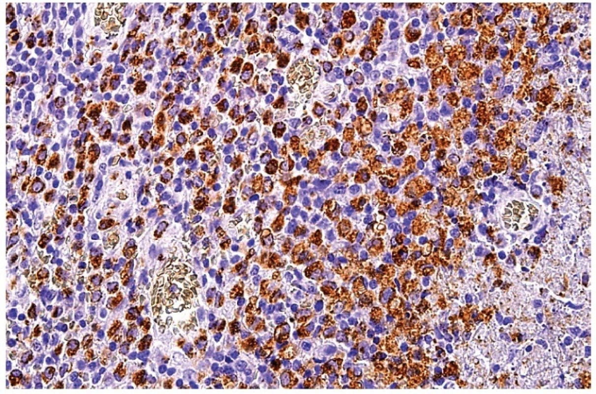 Průkaz molekuly CD68 v makrofázích ukazuje zrnitou reaktivitu velkých nepravidelně okrouhlých buněk soustředěných převážně v okolí nekrózy (částečně zastižena v pravé části obrázku). Středně velké buňky s homogenní pozitivitou zejména v centrální části obrázku jsou plazmacytoidní monocyty. Imunohistochemická reakce, dobarveno hematoxylinem (zvětšení 200x).