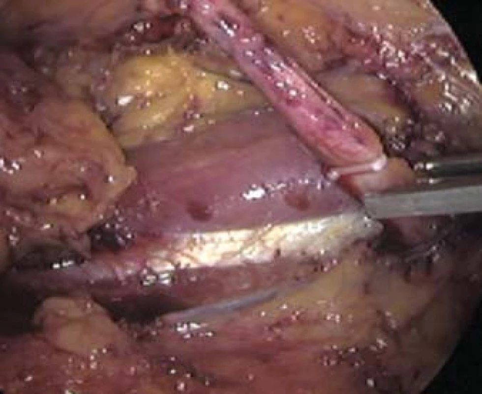 Snímek pořízený z videozáznamu z laparoskopie. Na vypreparovaný ureter (obr. 6) je naložen uzamykatelný klip Hem-o-lok&lt;sup&gt;®&lt;/sup&gt; Weck.