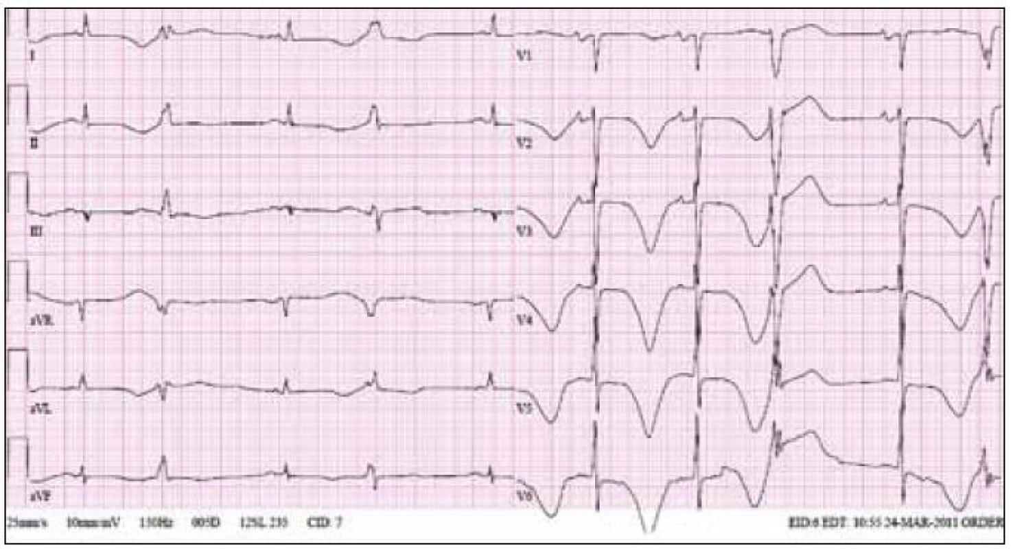 Ukázka EKG křivky od 63letého pacienta, kterému byl navzdory prodloužení intervalu QT na 530 ms za bazálních podmínek podán amiodaron v infuzích k zvládnutí epizod fibrilace síní. Je patrno extrémní prodloužení intervalu QT s bizarními vlnami T a bigeminicky vázanými komorovými extrasystolami. U tohoto pacienta došlo k rozvoji elektrické bouře na podkladě epizod torsade de pointes a situace byla zvládnuta dočasnou kardiostimulací a vysazením amiodaronu.