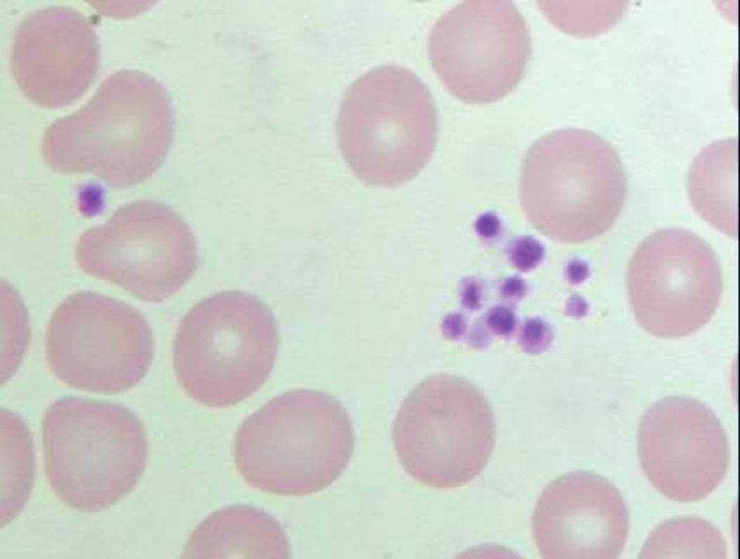 Pseudotrombocytopenie – snížení tendence trombocytů k agregaci (menší shluky) v nátěru periferní krve odebrané do K3 EDTA a po inkubaci ve vodní lázni o teplotě 37°C (počet trombocytů odečtených analyzátorem – 38 x 109/l).
