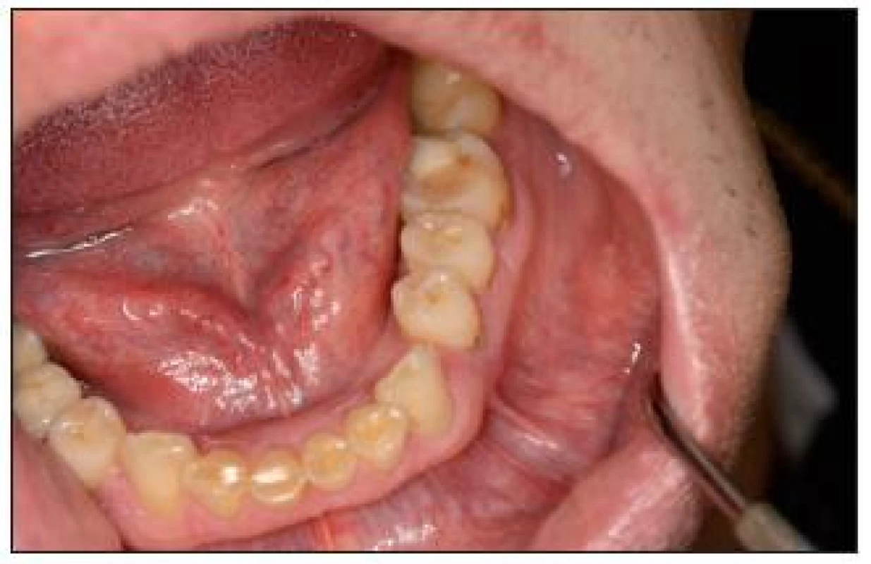 Počínající erozivní léze na distálních zubech dolní čelisti