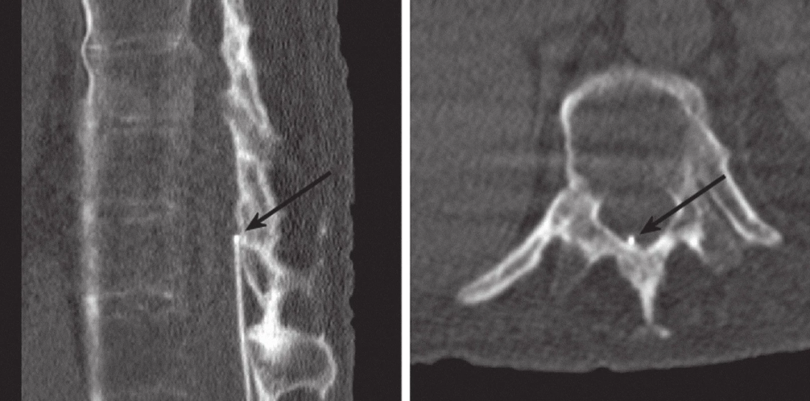 CT: katétr probíhá v epidurálním prostoru, hrot je při horním okraji Th 11 (označené šipkami). Sagitální řez po CT rekonstrukci (vlevo) a příčný řez (vpravo).